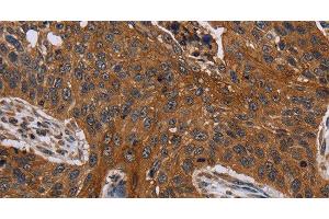 Immunohistochemistry of paraffin-embedded Human lung cancer using Catenin gamma Polyclonal Antibody at dilution of 1:40 (JUP 抗体)
