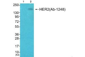Immunohistochemical analysis of paraffin-embedded human breast carcinoma tissue, using HER2 (phospho-Tyr1248) antibody. (ErbB2/Her2 抗体  (pTyr1248))