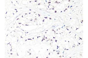 Immunohistochemistry of paraffin-embedded human gastric cancer using MTA2 Antibody (ABIN5998268) at dilution of 1/100 (40x lens). (MTA2 抗体)