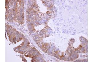 IHC-P Image BHMT antibody detects BHMT protein at cytosol on human colon carcinoma by immunohistochemical analysis. (BHMT 抗体)
