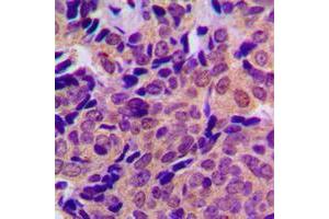 Immunohistochemical analysis of Beta Amyloid (pT743) staining in human breast cancer formalin fixed paraffin embedded tissue section. (beta Amyloid 抗体  (C-Term, pSer743))
