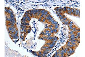 The image on the left is immunohistochemistry of paraffin-embedded Human colon cancer tissue using ABIN7128939(CHRM2 Antibody) at dilution 1/3, on the right is treated with fusion protein. (Muscarinic Acetylcholine Receptor M2 抗体)