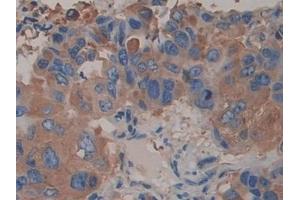 Detection of ACTN4 in Human Breast cancer Tissue using Polyclonal Antibody to Actinin Alpha 4 (ACTN4) (alpha Actinin 4 抗体  (AA 1-269))