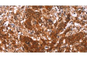 Immunohistochemistry of paraffin-embedded Human gastric cancer using HAS1 Polyclonal Antibody at dilution of 1:30 (HAS1 抗体)
