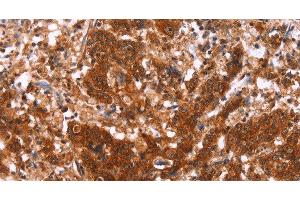 Immunohistochemistry of paraffin-embedded Human gastric cancer using HAS1 Polyclonal Antibody at dilution of 1:30 (HAS1 抗体)