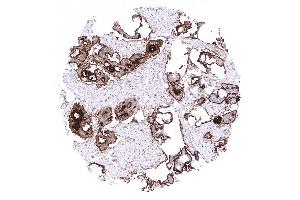 Ovary Strong predominantly membranous mesothelin staining in an endometroid ovarian cancer (Mesothelin 抗体  (AA 273-407))