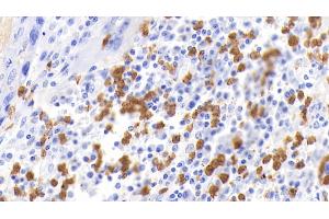 Detection of CALPRO in Human Lymphoma Tissue using Polyclonal Antibody to Calprotectin (CALPRO) (S100A8/A9 Complex (Calprotectin) 抗体  (AA 1-114))