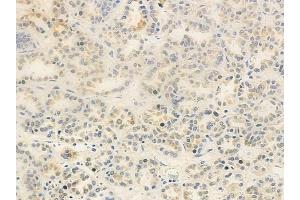 ABIN6263150 and ABIN6278791 at 1/100 staining human renal cell carcinoma by IHC-P. (MBIP 抗体  (Internal Region))