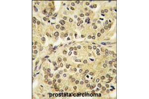 Formalin-fixed and paraffin-embedded human prostata carcinoma tissue reacted with TIEG antibody , which was peroxidase-conjugated to the secondary antibody, followed by DAB staining. (KLF10/TIEG1 抗体  (N-Term))