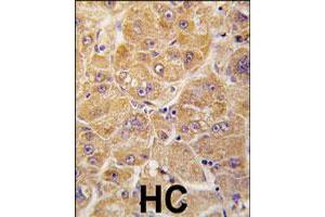 Formalin-fixed and paraffin-embedded human hepatocellular carcinoma reacted with ALDH1A1 polyclonal antibody  , which was peroxidase-conjugated to the secondary antibody, followed by DAB staining. (ALDH1A1 抗体  (Internal Region))