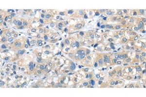 Immunohistochemistry of paraffin-embedded Human liver cancer tissue using PLXNA2 Polyclonal Antibody at dilution 1:40 (Plexin A2 抗体)