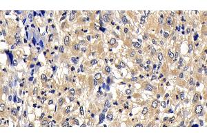 Detection of Bcl2L2 in Human Liver cancer Tissue using Polyclonal Antibody to B-Cell CLL/Lymphoma 2 Like Protein 2 (Bcl2L2) (BCL2L2 抗体  (AA 2-193))