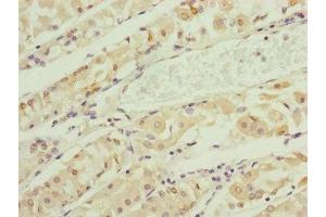 Immunohistochemistry of paraffin-embedded human gastric cancer using ABIN7151148 at dilution of 1:100 (RNF135 抗体  (AA 339-432))