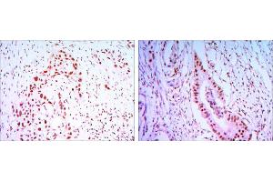 Immunohistochemical analysis of paraffin-embedded lung cancer tissues (left) and colon cancer tissues (right) using CDC27 antibody with DAB staining.