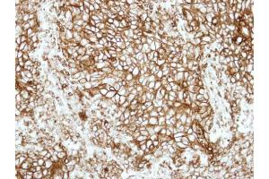 IHC-P Image Immunohistochemical analysis of paraffin-embedded human lung adenocarcinoma, using HLA-DRB1, antibody at 1:500 dilution. (HLA-DRB1 抗体)
