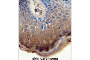 TJ antibody (N-term) 0762a immunohistochemistry analysis in formalin fixed and paraffin embedded human skin carcinoma followed by peroxidase conjugation of the secondary antibody and DAB staining. (TJAP1 抗体  (N-Term))