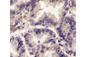 IHC analysis of FFPE human lung carcinoma tissue stained with VEGFC antibody (VEGFC 抗体  (AA 248-277))