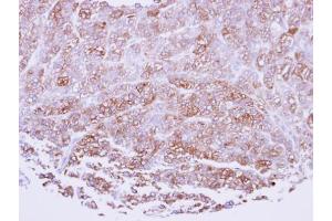 IHC-P Image Immunohistochemical analysis of paraffin-embedded human breast cancerncer, using ICAM2, antibody at 1:100 dilution. (ICAM2 抗体)