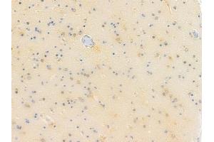 ABIN6257252 and ABIN6273611 at 1/100 staining human glioblastoma by IHC-P. (HSPB8 抗体  (C-Term))