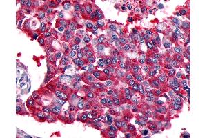 Anti-CALCRL / CGRP Receptor antibody IHC of human Lung, Non-Small Cell Carcinoma. (CALCRL 抗体  (Cytoplasmic Domain))