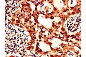 Immunohistochemistry of paraffin-embedded human lung cancer using ABIN7169181 at dilution of 1:100 (SIK1 抗体  (AA 492-750))