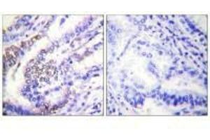Immunohistochemical analysis of paraffin-embedded human lung carcinoma tissue using Cyclin E1 antibody. (Cyclin E1 抗体)