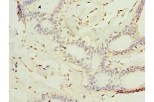 Immunohistochemistry of paraffin-embedded human breast cancer using ABIN7157236 at dilution of 1:100 (KATNAL2 抗体  (AA 18-307))
