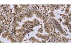 Immunohistochemistry of paraffin-embedded Human gastric cancer tissue using MCC Polyclonal Antibody at dilution 1:30 (MCC 抗体)