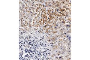 Immunohistochemical analysis of paraffin-embedded Human hepatocarcinoma tissue using (ABIN654629 and ABIN2844325) performed on the Leica® BOND RXm. (BCKDHB 抗体  (N-Term))