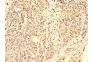 Immunohistochemistry of paraffin-embedded human ovarian cancer using ABIN7158545 at dilution of 1:100 (FCGR2C 抗体  (AA 43-223))