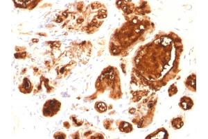 Formalin-fixed, paraffin-embedded human Breast Carcinoma stained with MUC1 Mouse Recombinant Monoclonal Antibody (rMUC1/960). (Recombinant MUC1 抗体)