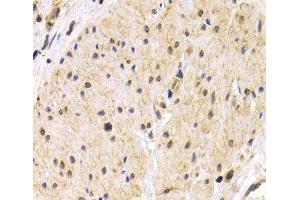 Immunohistochemistry of paraffin-embedded Human stomach cancer using TMPRSS2 Polyclonal Antibody at dilution of 1:200 (40x lens). (TMPRSS2 抗体)