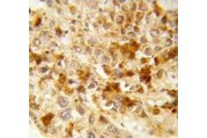Immunohistochemistry analysis of human hepatocarcinoma (Formalin-fixed, Paraffin-embedded)  using Peroxin 2 / PEX2 / RNF72  Antibody , followed by peroxidase-conjugated secondary antibody and DAB staining. (PEX2 抗体  (Middle Region))