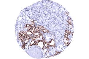 Thyroid CDH16 negative papillary carcinoma invading CDH16 positive normal thyroid CDH16 immunohistochemistry (Recombinant Cadherin-16 抗体)