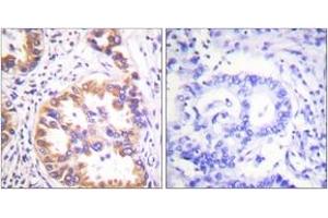 Immunohistochemistry analysis of paraffin-embedded human lung carcinoma, using Tuberin/TSC2 (Phospho-Ser939) Antibody. (Tuberin 抗体  (pSer939))