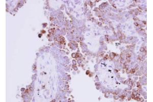 IHC-P Image Immunohistochemical analysis of paraffin-embedded human lung adenocarcinoma, using Ribonuclease A, antibody at 1:250 dilution. (RNASE1 抗体  (Center))