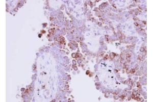 IHC-P Image Immunohistochemical analysis of paraffin-embedded human lung adenocarcinoma, using Ribonuclease A, antibody at 1:250 dilution.