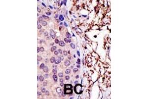 Formalin-fixed and paraffin-embedded human cancer tissue reacted with the primary antibody, which was peroxidase-conjugated to the secondary antibody, followed by AEC staining. (UBE2L3 抗体  (N-Term))