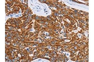 The image on the left is immunohistochemistry of paraffin-embedded Human esophagus cancer tissue using ABIN7191483(MMP21 Antibody) at dilution 1/15, on the right is treated with synthetic peptide. (MMP21 抗体)