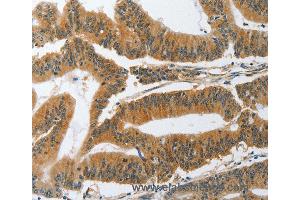 Immunohistochemistry of Human gastric cancer using PIK3R3 Polyclonal Antibody at dilution of 1:45 (PIK3R3 抗体)