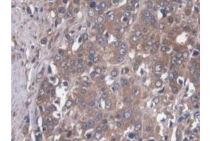 DAB staining on IHC-P; Samples: Human Prostate cancer Tissue (MAP4 抗体  (AA 243-549))