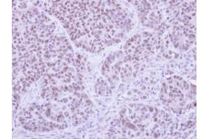 IHC-P Image Immunohistochemical analysis of paraffin-embedded SW480 xenograft , using FHL5, antibody at 1:500 dilution. (FHL5 抗体)