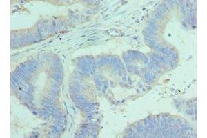 Immunohistochemistry of paraffin-embedded human colon cancer using ABIN7144450 at dilution of 1:100 (BCL2L14 抗体  (AA 1-327))