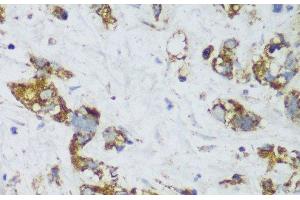 Immunohistochemistry of paraffin-embedded Human gastric cancer using ECH1 Polyclonal Antibody at dilution of 1:150 (40x lens). (ECH1 抗体)