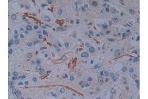 Detection of PLS3 in Human Prostate cancer Tissue using Polyclonal Antibody to Plastin 3 (PLS3) (Plastin 3 抗体  (AA 379-630))