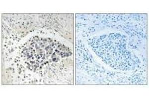 Immunohistochemistry analysis of paraffin-embedded human lung carcinoma tissue using CPNE8 antibody. (CPNE8 抗体  (N-Term))