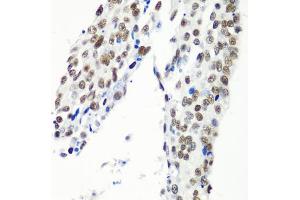 Immunohistochemistry of paraffin-embedded human lung cancer using HT antibody  at dilution of 1:100 (40x lens). (HTATSF1 抗体  (AA 1-270))