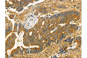beta-Tubulin Antibody at 1/100 staining Human colorectal cancer by IHC-P.