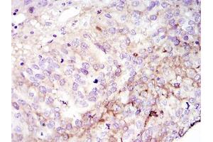Immunohistochemical analysis of paraffin-embedded cervices tumour using FAK mouse mAb with DAB staining (FAK 抗体)