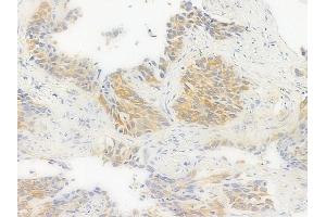 ABIN6256392 and ABIN6267376 at 1/100 staining human lung squamous cell carcinoma by IHC-P. (Glycogen Synthase 抗体  (pSer645))